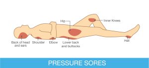 346773920-920-pressure-sore-diagram