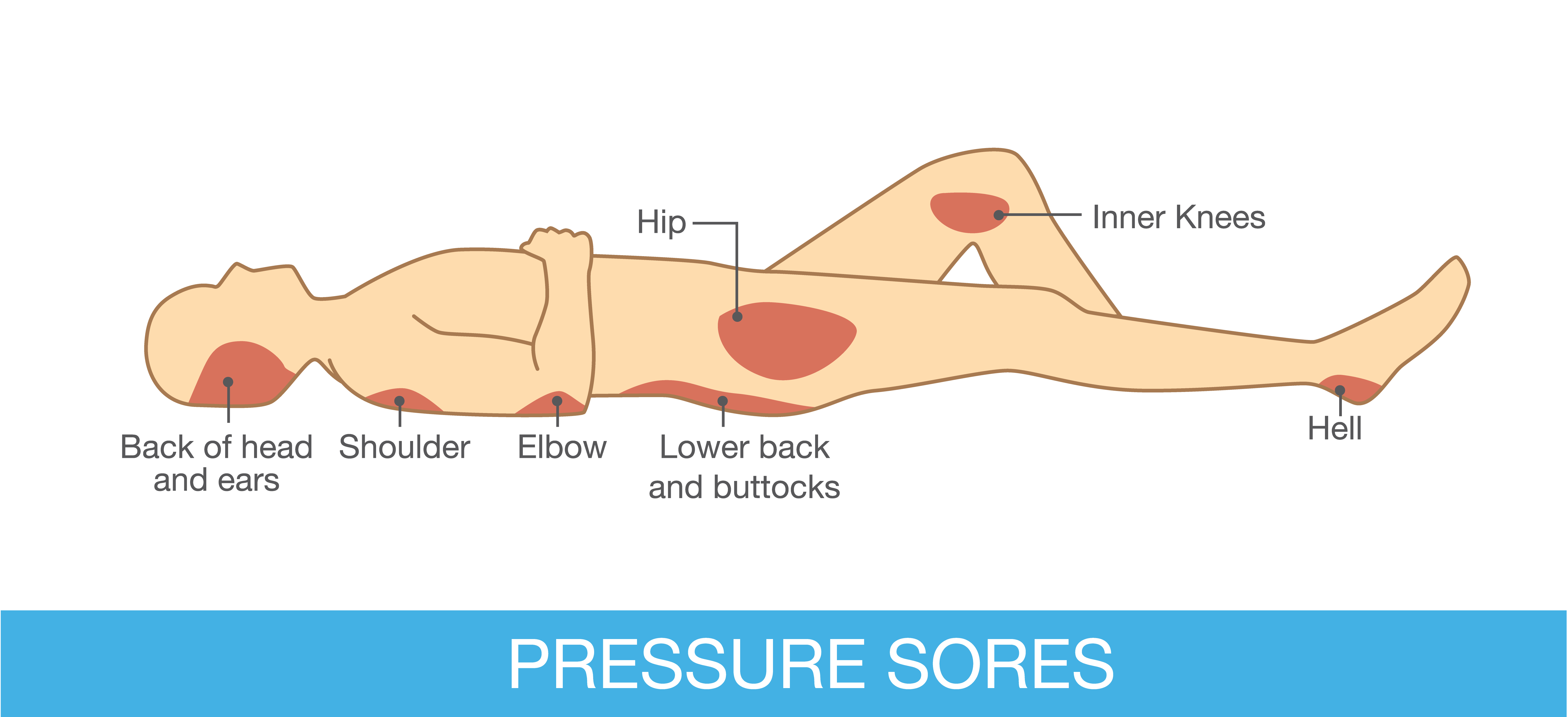 Development Of Pressure Ulcers  Causes And Signs