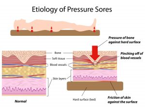 89421034-dev-of-press-ulcers