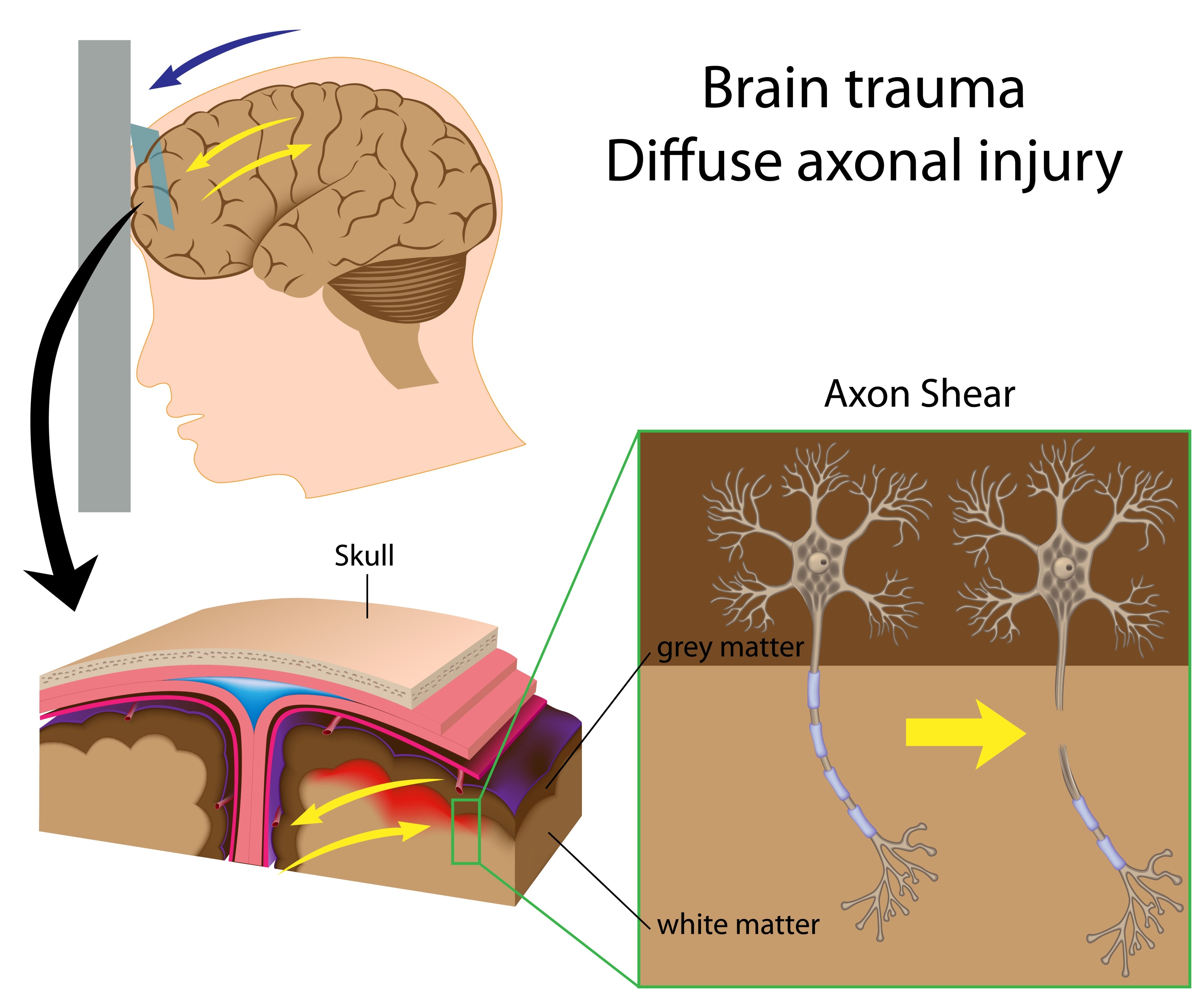 Diffuse Brain Injury Scottish Acquired Brain Injury Network elearning